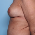 Mommy Makeover Before & After Patient #34313
